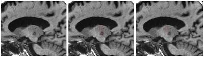 Tremor suppression following treatment with MRgFUS: skull density ratio consistency and degree of posterior dentatorubrothalamic tract lesioning predicts long-term clinical outcomes in essential tremor